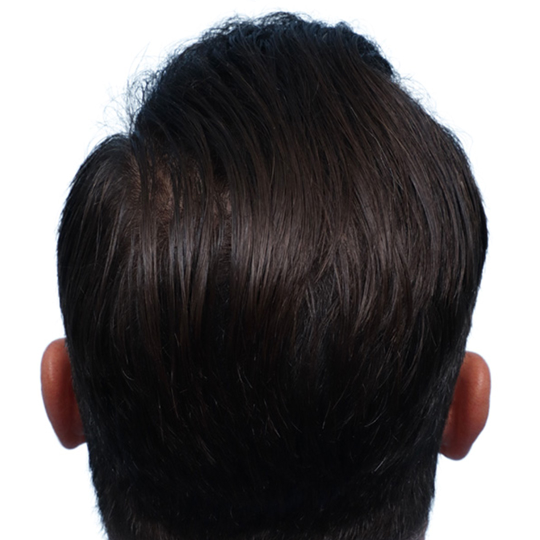 Fue Before and After | Dr. Jeffrey Wise