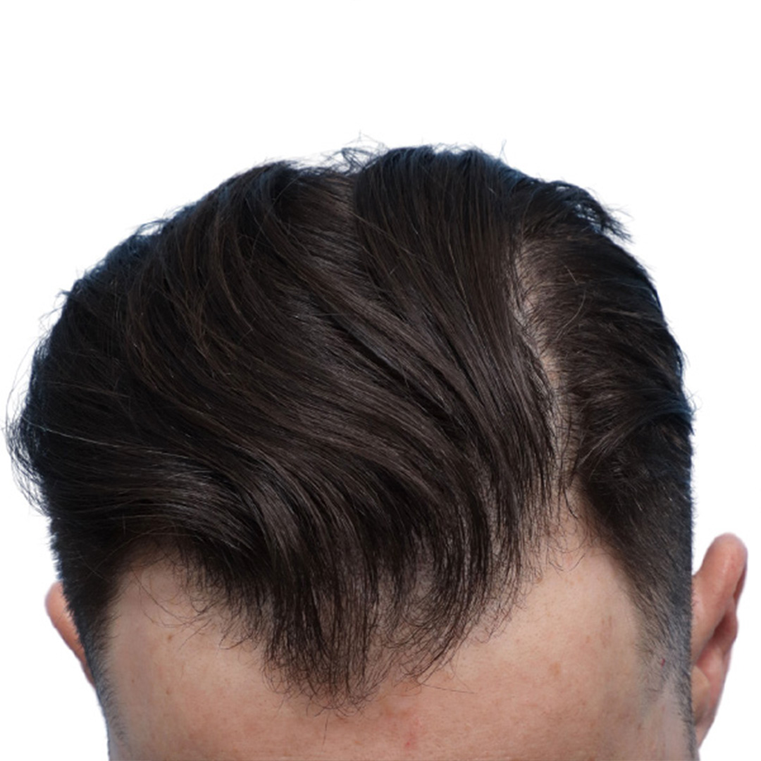 Fue Before and After | Dr. Jeffrey Wise