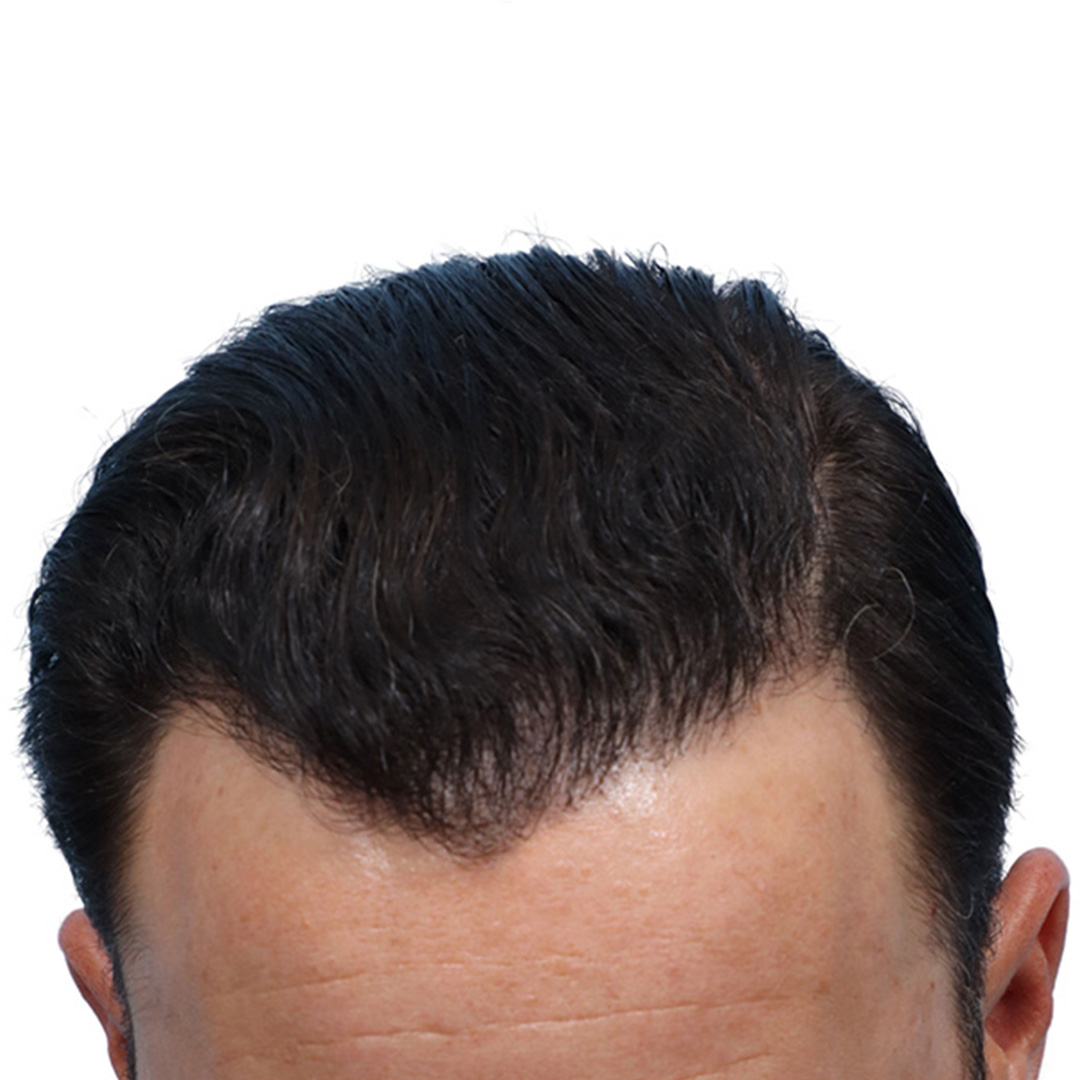 Fue Before and After | Dr. Jeffrey Wise