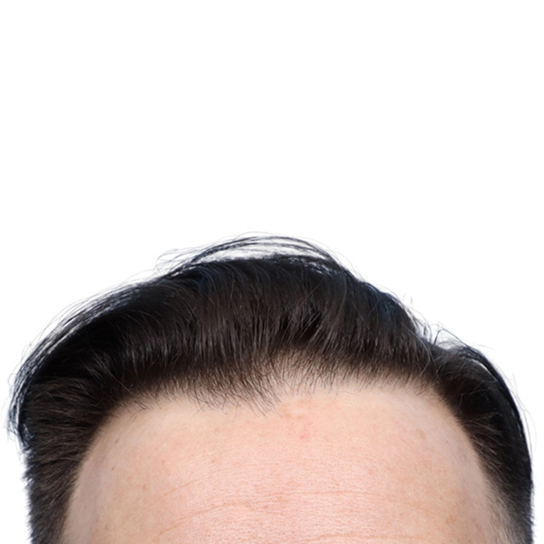 Fue Before and After | Dr. Jeffrey Wise