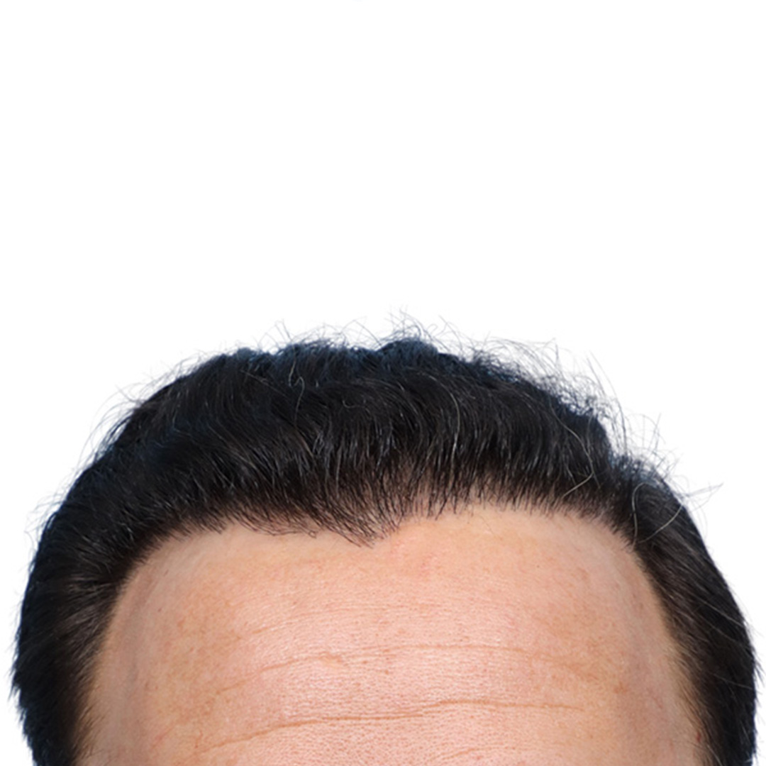 Fue Before and After | Dr. Jeffrey Wise