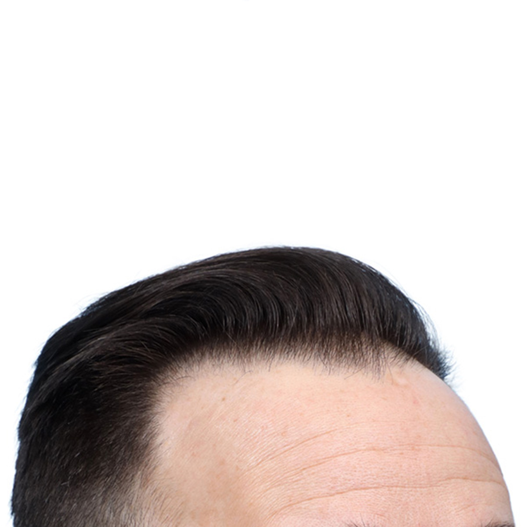 Fue Before and After | Dr. Jeffrey Wise