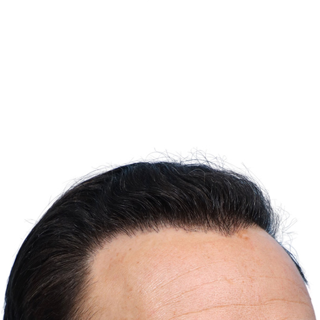 Fue Before and After | Dr. Jeffrey Wise