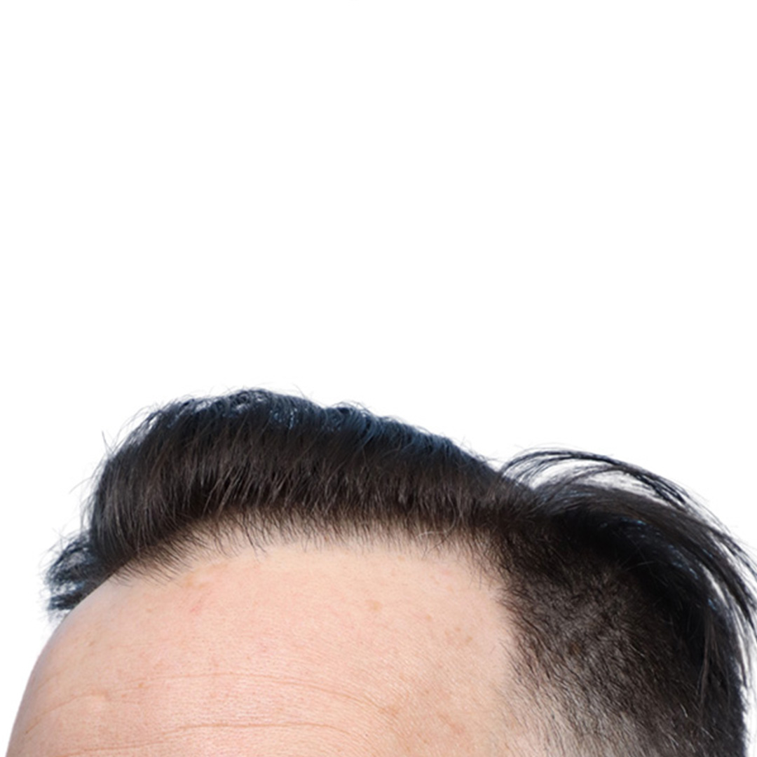 Fue Before and After | Dr. Jeffrey Wise