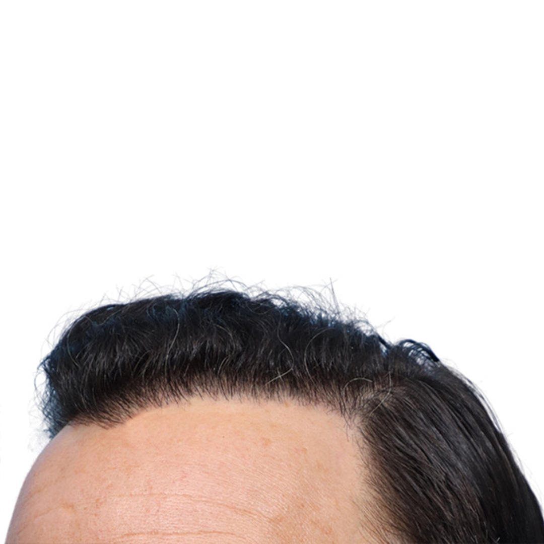 Fue Before and After | Dr. Jeffrey Wise