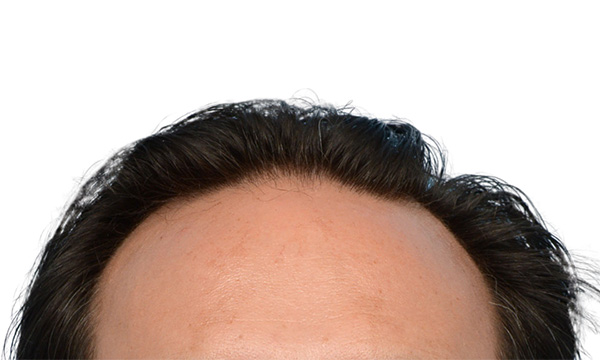 Fue Before and After | Dr. Jeffrey Wise