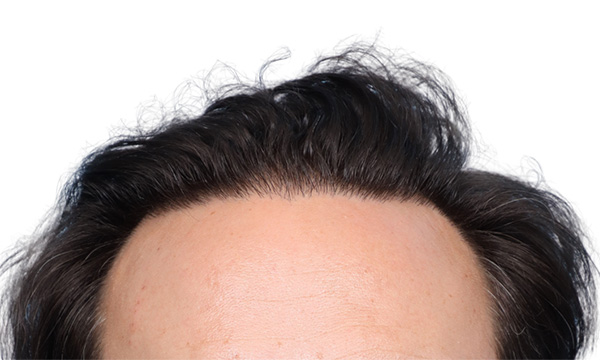 Fue Before and After | Dr. Jeffrey Wise