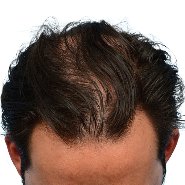 Fue Before and After | Dr. Jeffrey Wise