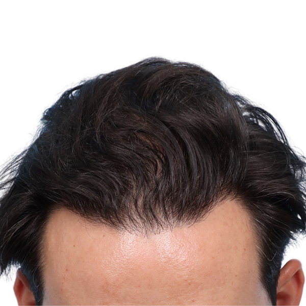 Fue Before and After | Dr. Jeffrey Wise