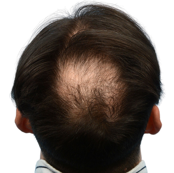 Fue Before and After | Dr. Jeffrey Wise