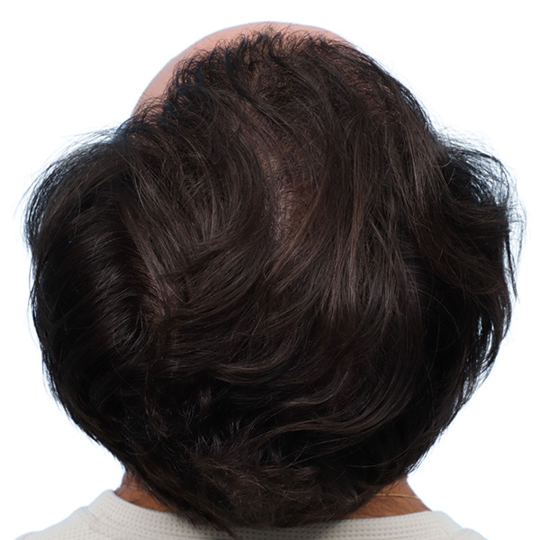 Fue Before and After | Dr. Jeffrey Wise