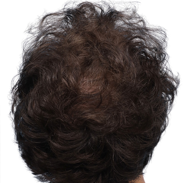 Fue Before and After | Dr. Jeffrey Wise