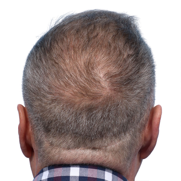 Fue Before and After | Dr. Jeffrey Wise