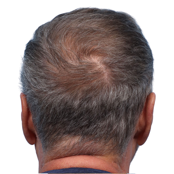 Fue Before and After | Dr. Jeffrey Wise