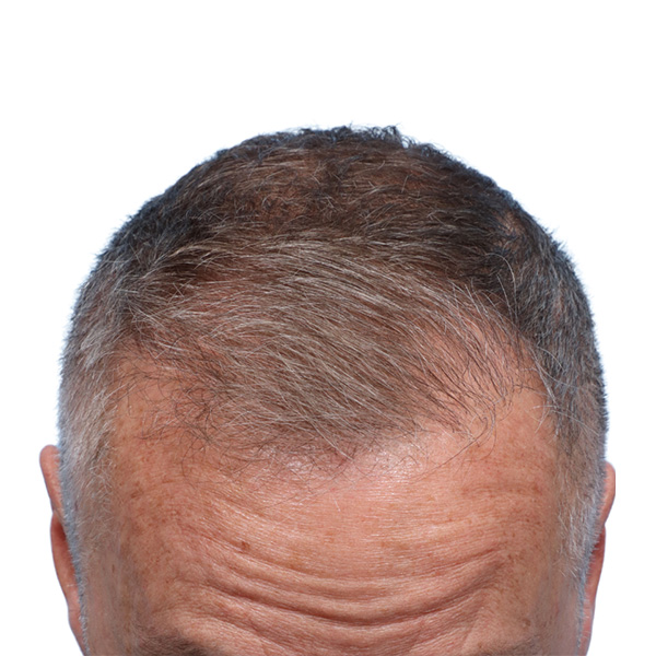 Fue Before and After | Dr. Jeffrey Wise