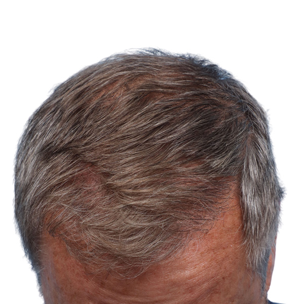 Fue Before and After | Dr. Jeffrey Wise