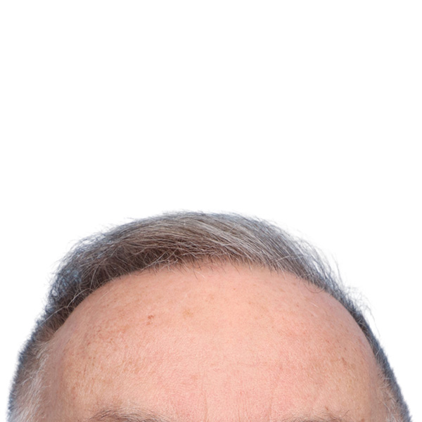 Fue Before and After | Dr. Jeffrey Wise