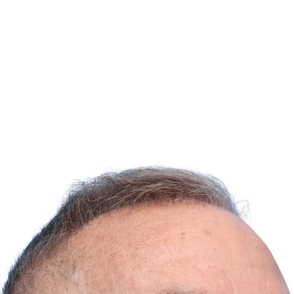 Fue Before and After | Dr. Jeffrey Wise