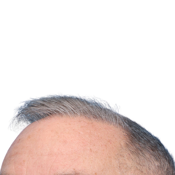 Fue Before and After | Dr. Jeffrey Wise