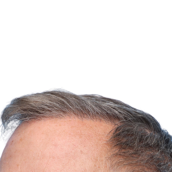 Fue Before and After | Dr. Jeffrey Wise