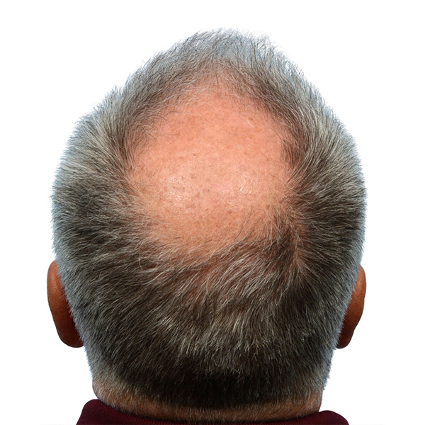 Fue Before and After | Dr. Jeffrey Wise