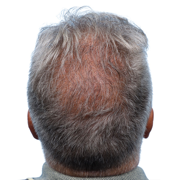 Fue Before and After | Dr. Jeffrey Wise