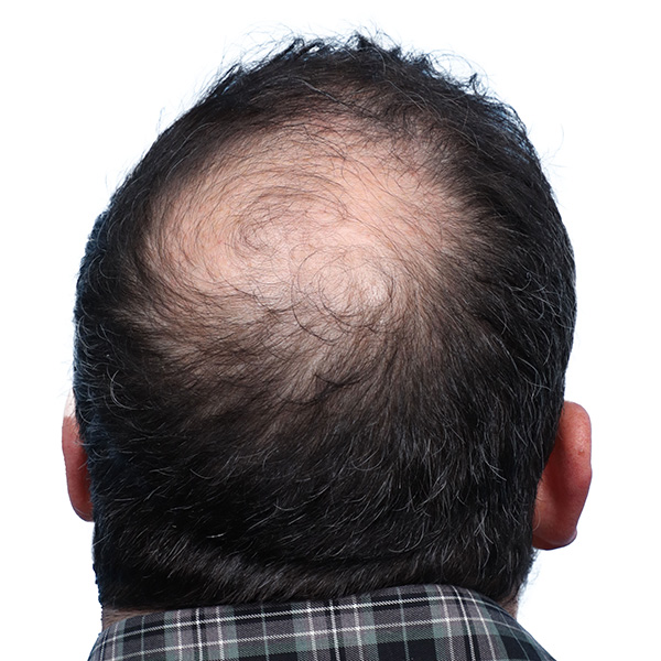 Fue Before and After | Dr. Jeffrey Wise