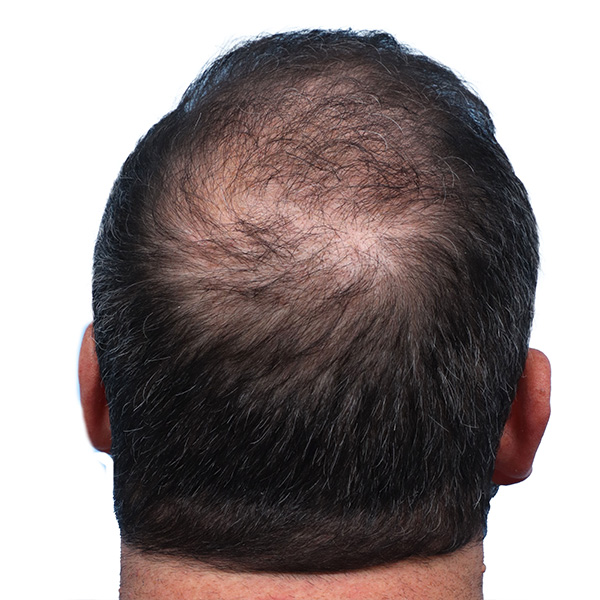 Fue Before and After | Dr. Jeffrey Wise