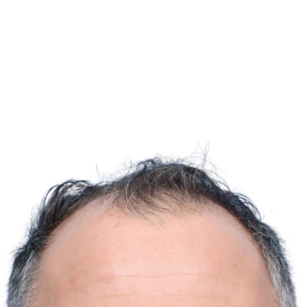 Fue Before and After | Dr. Jeffrey Wise