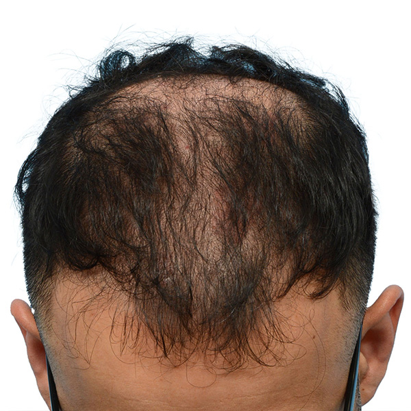 Fue Before and After | Dr. Jeffrey Wise