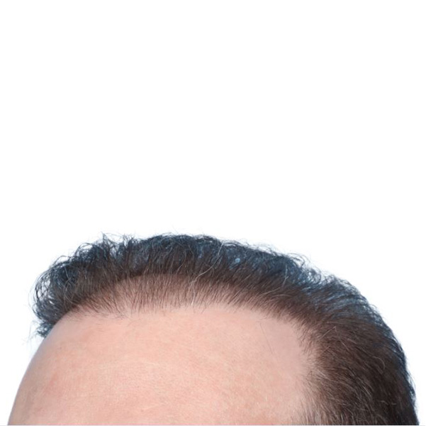 Fue Before and After | Dr. Jeffrey Wise