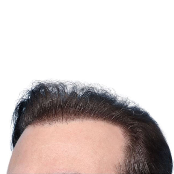 Fue Before and After | Dr. Jeffrey Wise