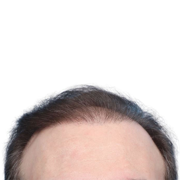 Fue Before and After | Dr. Jeffrey Wise