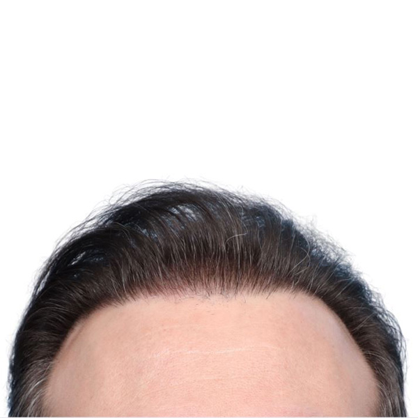 Fue Before and After | Dr. Jeffrey Wise