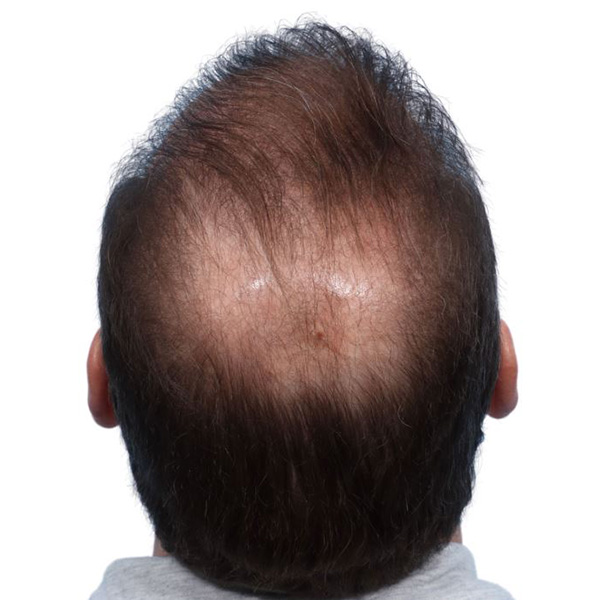 Fue Before and After | Dr. Jeffrey Wise