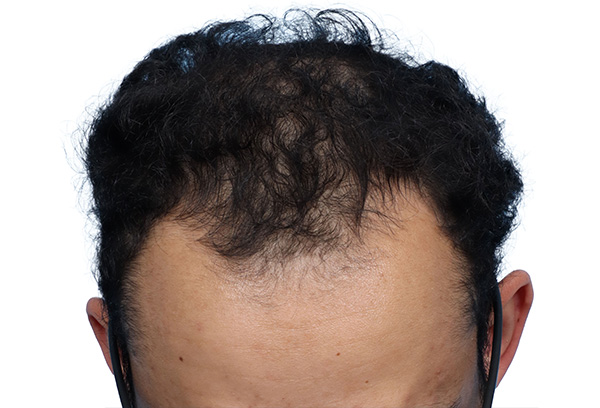 Fue Before and After | Dr. Jeffrey Wise