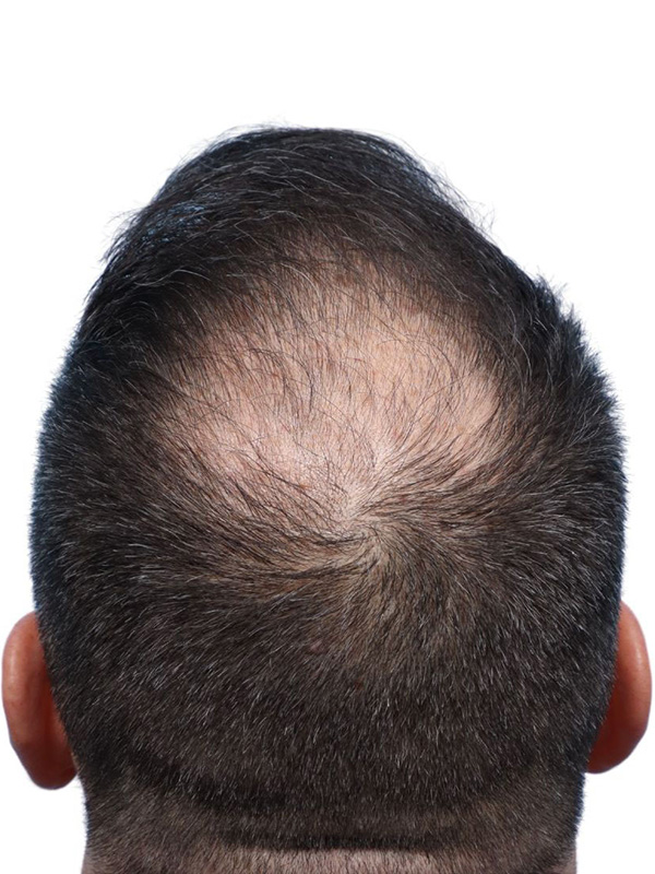 Fue Before and After | Dr. Jeffrey Wise