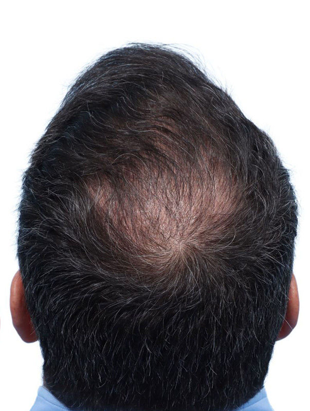 Fue Before and After | Dr. Jeffrey Wise