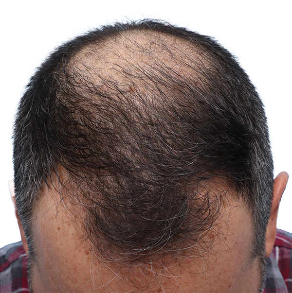 Fue Before and After | Dr. Jeffrey Wise