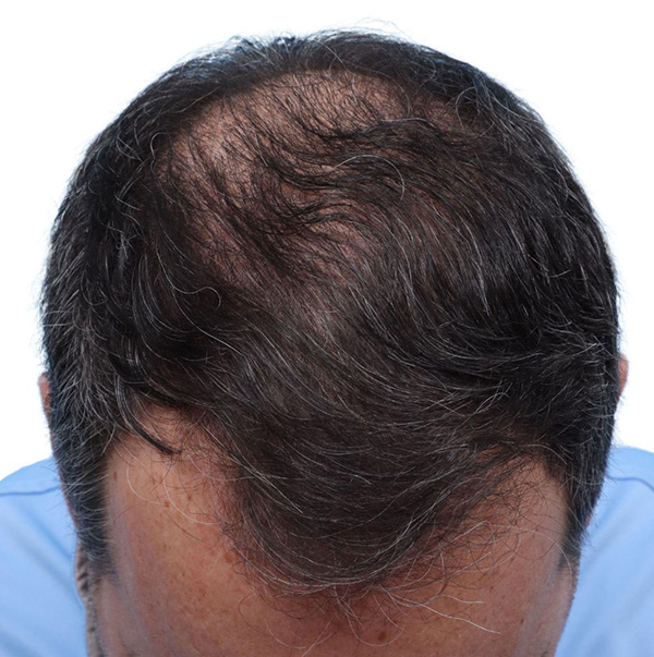 Fue Before and After | Dr. Jeffrey Wise