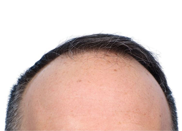 Fue Before and After | Dr. Jeffrey Wise