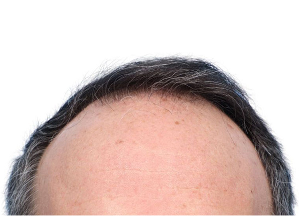 Fue Before and After | Dr. Jeffrey Wise