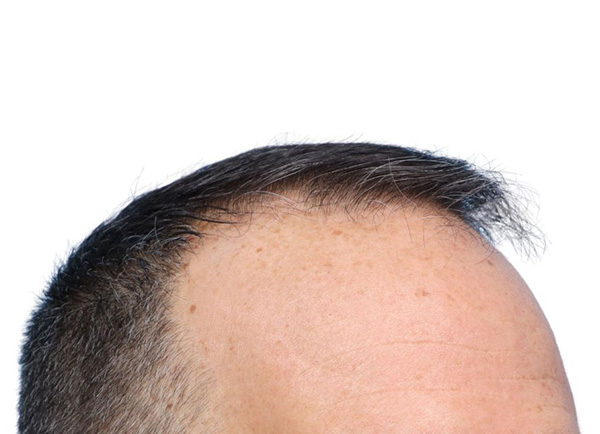 Fue Before and After | Dr. Jeffrey Wise