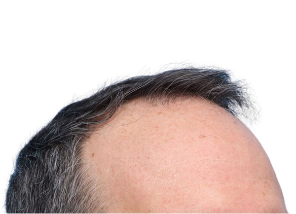 Fue Before and After | Dr. Jeffrey Wise