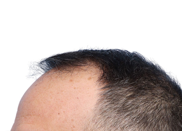 Fue Before and After | Dr. Jeffrey Wise