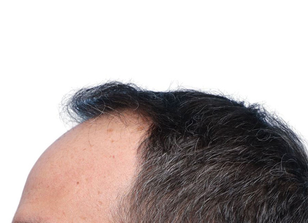 Fue Before and After | Dr. Jeffrey Wise