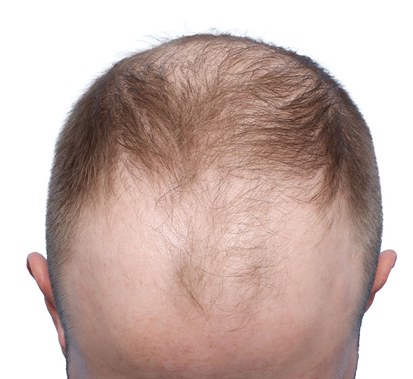 Fue Before and After | Dr. Jeffrey Wise