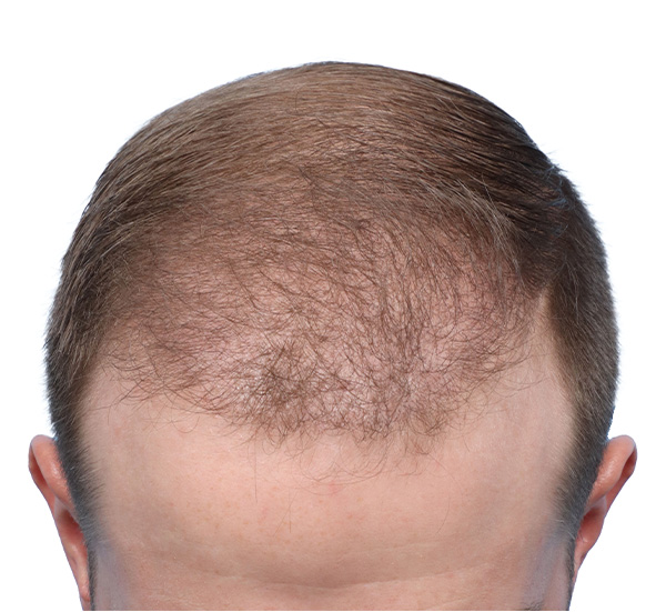 Fue Before and After | Dr. Jeffrey Wise