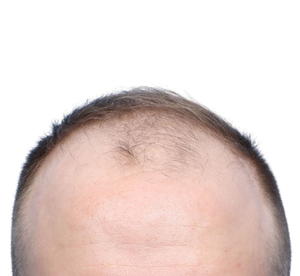 Fue Before and After | Dr. Jeffrey Wise