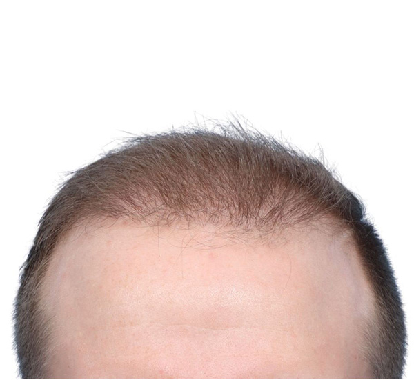 Fue Before and After | Dr. Jeffrey Wise